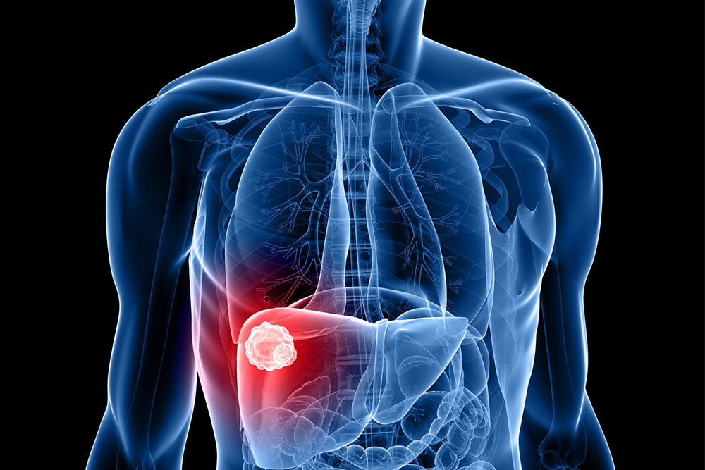 How to Prevent Liver Damage and the Development of Cancer